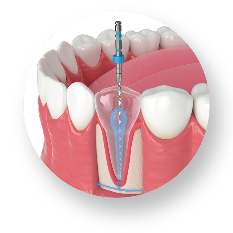 Mikroskopická endodoncia (liečba koreňových kanálikov) 